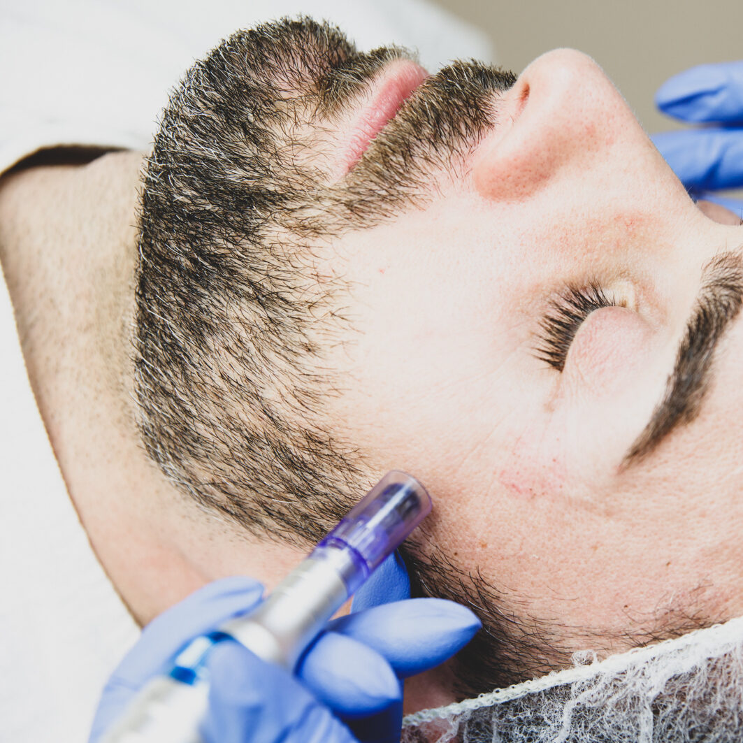 Microneedling in Düsseldorf